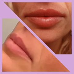 Filler labbra - Med Medicina e Chirurgia Estetica