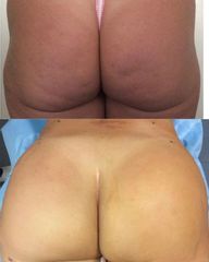 Gluteoplastica - Med Medicina e Chirurgia Estetica