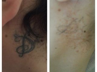 Rimozione tattoo prima e dopo