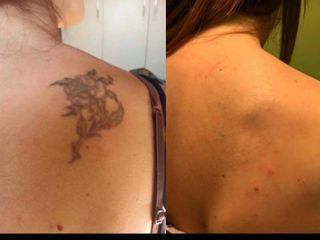 Rimozione tattoo prima e dopo