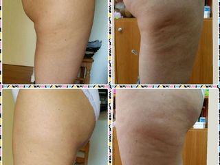 Cellulite prima e dopo
