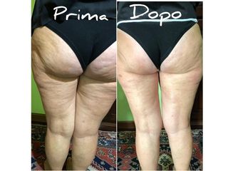 Cellulite prima e dopo