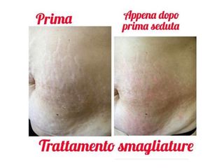 Smagliature prima e dopo