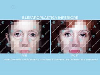 Blefaroplastica prima e dopo