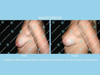 mastopessi prima e dopo
