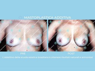 Mastoplastica additiva prima e dopo