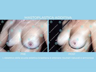 Mastoplastica additiva prima e dopo
