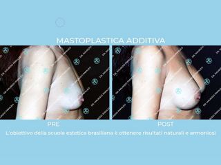 Mastoplastica additiva prima e dopo