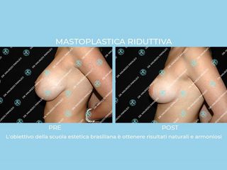 mastoplastica riduttiva prima e dopo