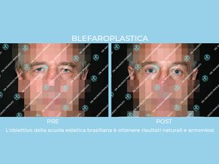 blefaropalstica prima e dopo