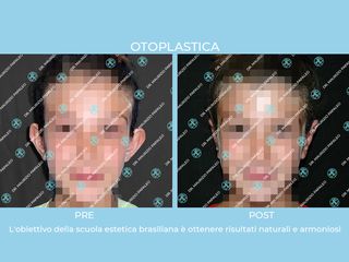 otoplastica prima e dopo
