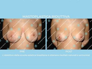 mastoplastica riduttiva prima e dopo