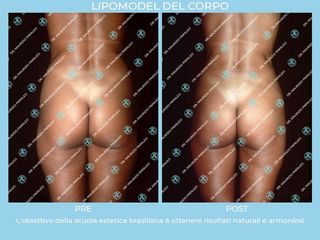 Liposuzione prima e dopo