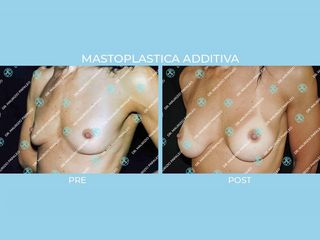 Mastoplastica additiva prima e dopo