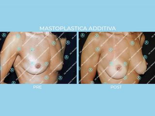 Mastoplastica additiva prima e dopo