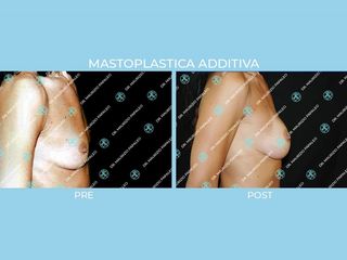 Mastoplastica additiva prima e dopo