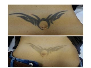 Rimozione tatuaggi prima e dopo