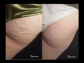 Velasmooth prima e dopo