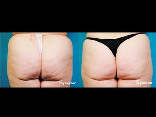Velasmooth prima e dopo