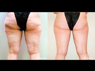 Velasmooth prima e dopo