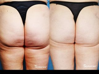 Velasmooth prima e dopo