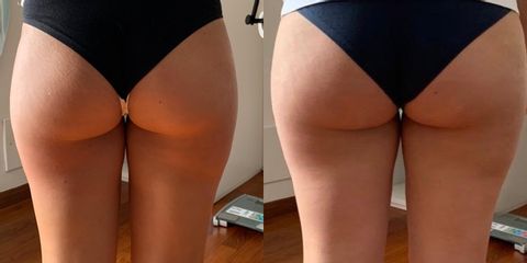 Cellulite - Aesthetic Medical Center Di Galdieri Dott.ssa Raffaella