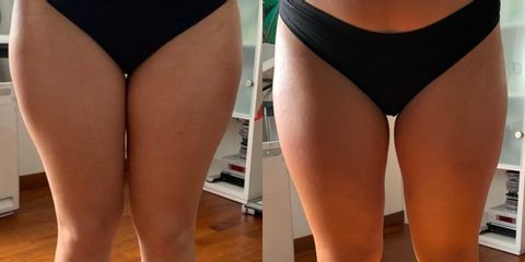 Cellulite - Aesthetic Medical Center Di Galdieri Dott.ssa Raffaella