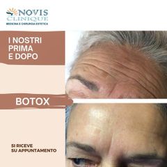 Botulino - Novis Clinique
