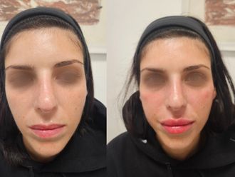 Filler labbra prima e dopo - 876745