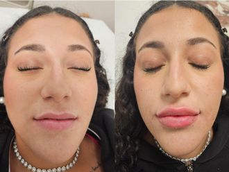 Filler labbra prima e dopo - 876746