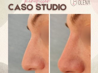 Rinofiller prima e dopo - 877166