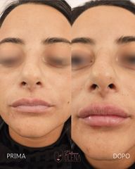 Dott.ssa Olena Zinchenko Filler Labbra