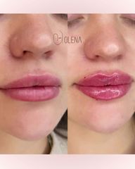 Dott.ssa Olena Zinchenko Filler Labbra