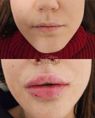 Dott.ssa Olena Zinchenko Filler Labbra