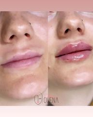 Dott.ssa Olena Zinchenko Filler Labbra