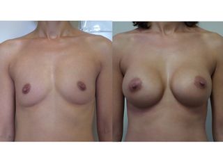 Mastoplastica Additiva Pre e Post