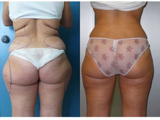 Liposuzione prima e dopo