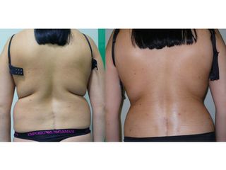 Liposuzione prima e dopo