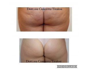 Cellulite prima e dopo