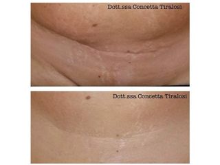 Cicatrici prima e dopo