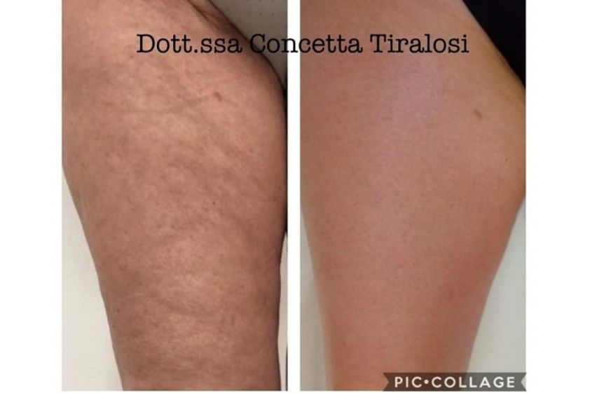 Smagliature prima e dopo - 766738