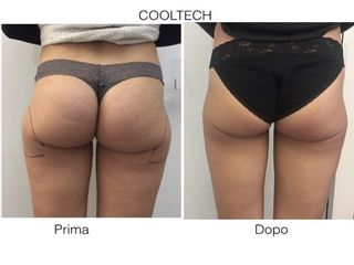 liposuzione prima dopo