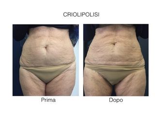 criolipolisi prima dopo