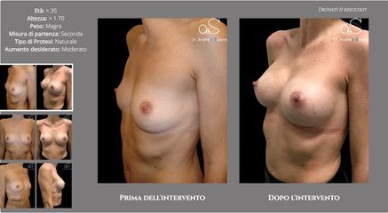 Mastoplastica additiva - Clinica San Martino