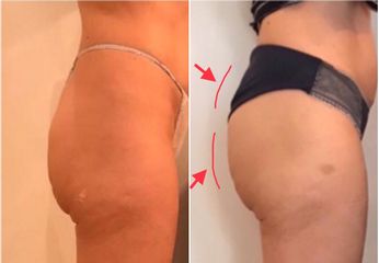 Emsculpt prima e dopo