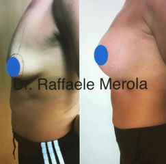 Mastoplastica additiva - Dott. Raffaele Merola