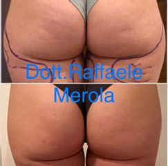 Liposuzione - Dott. Raffaele Merola