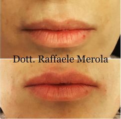 Filler labbra - Dott. Raffaele Merola