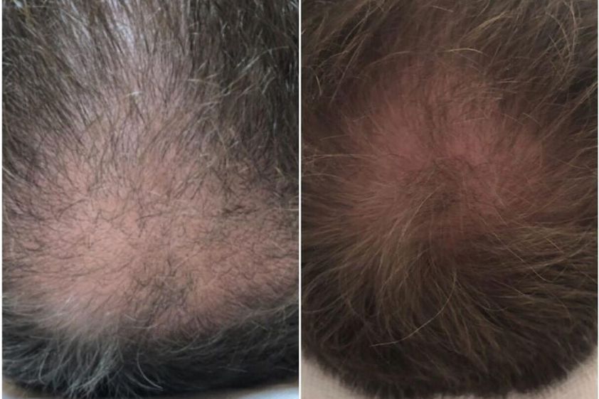 Alopecia prima e dopo - 773405