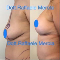 Mastoplastica additiva - Dott. Raffaele Merola